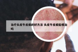 治疗头皮牛皮癣的好方法 头皮牛皮癣能根治吗