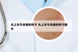 头上长牛皮癣的样子 头上长牛皮癣的样子图片
