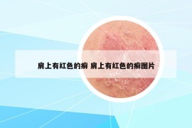 肩上有红色的癣 肩上有红色的癣图片