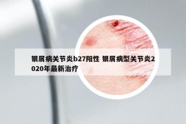 银屑病关节炎b27阳性 银屑病型关节炎2020年最新治疗