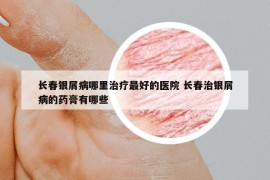 长春银屑病哪里治疗最好的医院 长春治银屑病的药膏有哪些