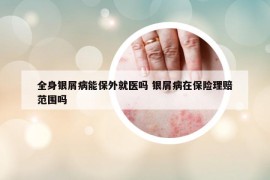 全身银屑病能保外就医吗 银屑病在保险理赔范围吗