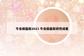 牛皮癣最新2023 牛皮癣最新研究成果