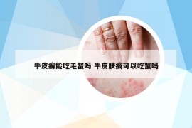 牛皮癣能吃毛蟹吗 牛皮肤癣可以吃蟹吗