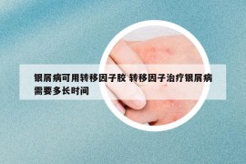 银屑病可用转移因子胶 转移因子治疗银屑病需要多长时间