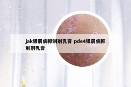 jak银屑病抑制剂乳膏 pde4银屑病抑制剂乳膏