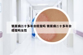 银屑病二十多年会癌变吗 银屑病二十多年会癌变吗女性
