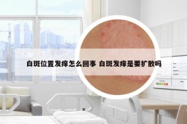 白斑位置发痒怎么回事 白斑发痒是要扩散吗