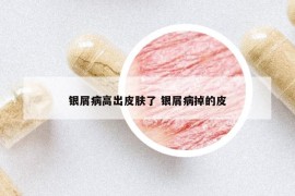 银屑病高出皮肤了 银屑病掉的皮