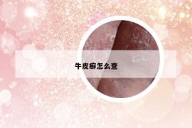 牛皮癣怎么查