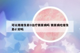 可以用维生素D治疗银屑病吗 银屑病吃维生素d 好吗