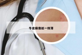牛皮癣像纸一样薄