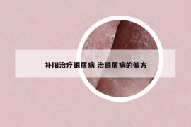 补阳治疗银屑病 治银屑病的偏方