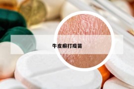 牛皮癣打疫苗
