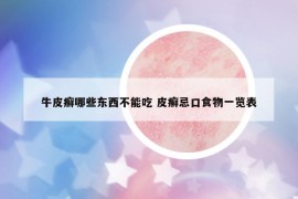 牛皮癣哪些东西不能吃 皮癣忌口食物一览表