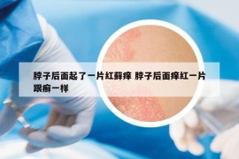 脖子后面起了一片红藓痒 脖子后面痒红一片跟癣一样