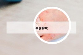 牛皮癣哎