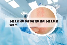 小腿上有鳞屑不痛不痒是银屑病 小腿上银屑病图片