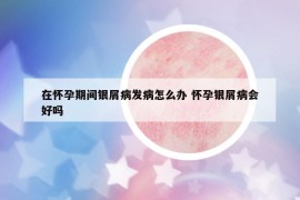 在怀孕期间银屑病发病怎么办 怀孕银屑病会好吗