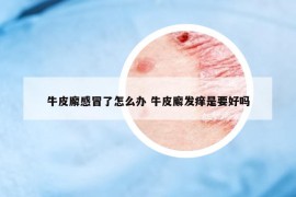 牛皮廨感冒了怎么办 牛皮廨发痒是要好吗