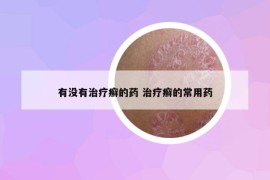 有没有治疗癣的药 治疗癣的常用药