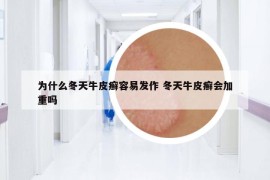 为什么冬天牛皮癣容易发作 冬天牛皮癣会加重吗