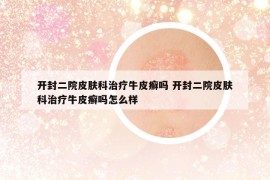 开封二院皮肤科治疗牛皮癣吗 开封二院皮肤科治疗牛皮癣吗怎么样