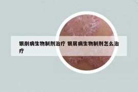 银削病生物制剂治疗 银屑病生物制剂怎么治疗