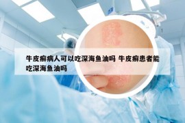 牛皮癣病人可以吃深海鱼油吗 牛皮癣患者能吃深海鱼油吗