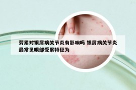 劳累对银屑病关节炎有影响吗 银屑病关节炎最常见眼部受累特征为