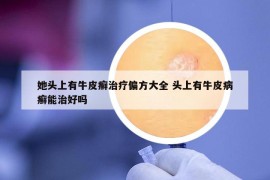 她头上有牛皮癣治疗偏方大全 头上有牛皮病癣能治好吗