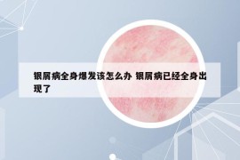 银屑病全身爆发该怎么办 银屑病已经全身出现了
