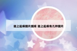 腿上起癣图片图库 腿上起癣有几种图片