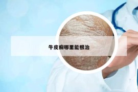 牛皮癣哪里能根治
