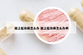 腿上起白癣怎么办 腿上起白癣怎么办啊