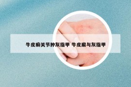 牛皮癣关节肿灰指甲 牛皮廨与灰指甲