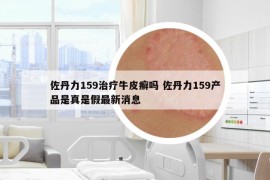 佐丹力159治疗牛皮癣吗 佐丹力159产品是真是假最新消息