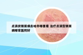点滴状银屑病去哈市哪里看 治疗点滴型银屑病哪家医院好