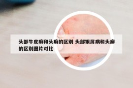 头部牛皮癣和头癣的区别 头部银屑病和头癣的区别图片对比
