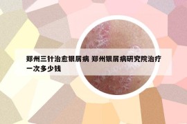 郑州三针治愈银屑病 郑州银屑病研究院治疗一次多少钱