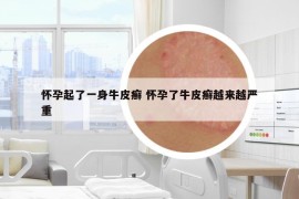 怀孕起了一身牛皮癣 怀孕了牛皮癣越来越严重