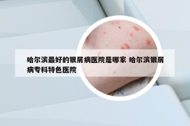 哈尔滨最好的银屑病医院是哪家 哈尔滨银屑病专科特色医院