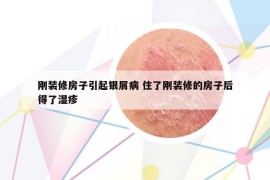 刚装修房子引起银屑病 住了刚装修的房子后得了湿疹