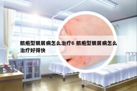 脓疱型银屑病怎么治疗6 脓疱型银屑病怎么治疗好得快