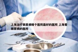 上海治疗银屑病哪个医院最好的医院 上海看银屑病的医院