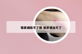 银屑病除不了跟 银屑病治不了