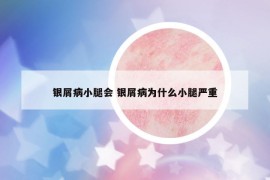 银屑病小腿会 银屑病为什么小腿严重