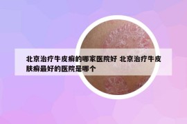 北京治疗牛皮癣的哪家医院好 北京治疗牛皮肤癣最好的医院是哪个