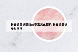长春银屑病医院的专家怎么预约 长春银屑病专科医院