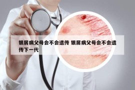 银屑病父母会不会遗传 银屑病父母会不会遗传下一代
